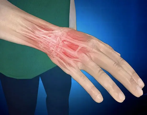 Chơi Cầu Lông Bị Đau Cổ Tay: Nguyên Nhân, Cách Xử Lý Và Phòng Ngừa Hiệu Quả Chơi Cầu Lông Bị Đau Cổ Tay: Nguyên Nhân, Cách Xử Lý Và Phòng Ngừa Hiệu Quả