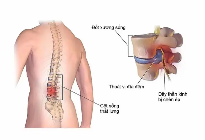 Đánh Cầu Lông Bị Đau Lưng: Nguyên Nhân, Cách Xử Lý & Phòng Ngừa Hiệu Quả