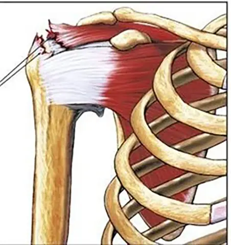 Tác Hại Tiềm Ẩn Của Đánh Cầu Lông: Chấn Thương Thường Gặp Và Cách Phòng Tránh Tác Hại Tiềm Ẩn Của Đánh Cầu Lông: Chấn Thương Thường Gặp Và Cách Phòng Tránh